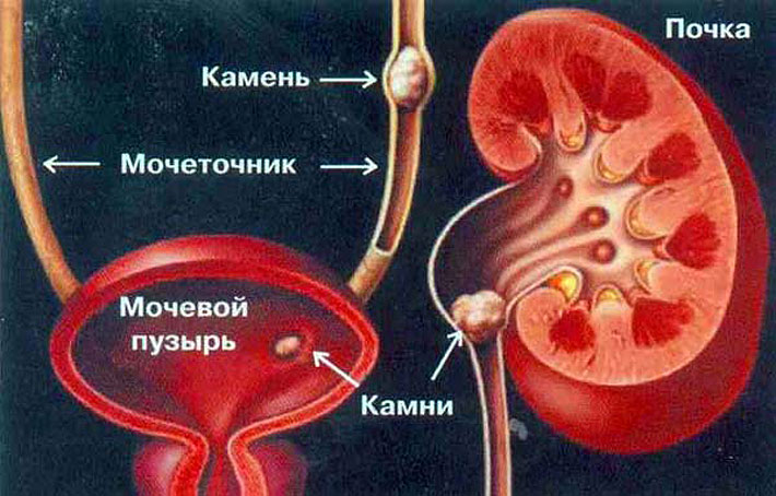 Бубрежни камен: третман са људским правима