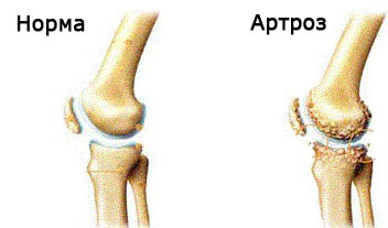 Лечење фолне артрозе коленског зглоба