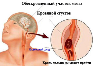 Лечење атеросклерозе са народним лековима