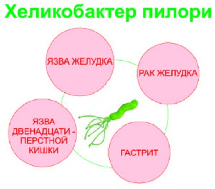 Лечење желудачних улкуса са људским лековима