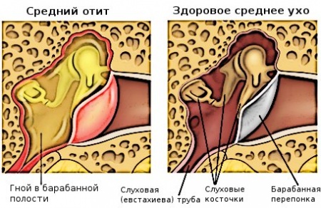 Како лијечити отитис код куће?