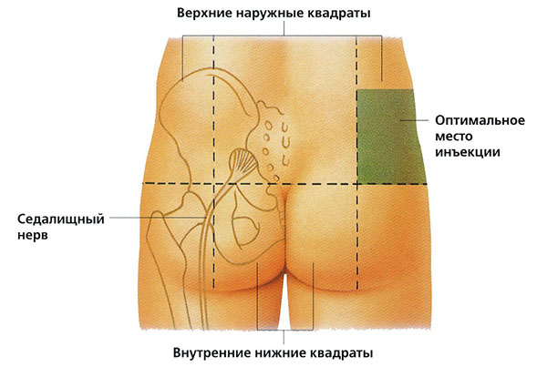 Како интраваскуларно убризгати ињекцију у задњицу