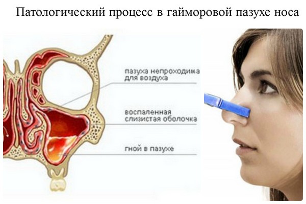 Бровн Бровн: зашто је важно почети лијечење на вријеме